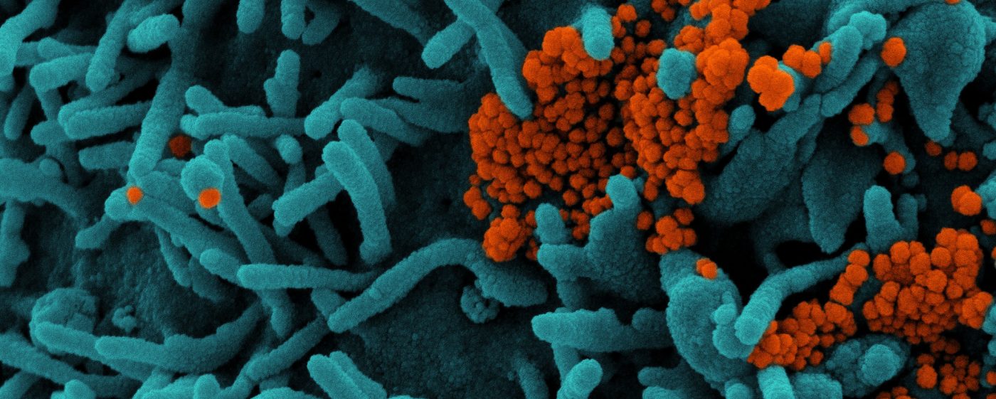 Cell infected with SARS-CoV-2 virus, the novel coronavirus responsible for COVID-19